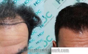 Front view - Before and after