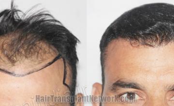 before and after result photographs