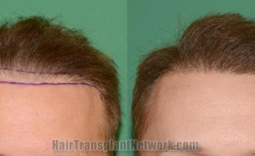 before and after result photographs
