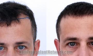 Front view - Before and after