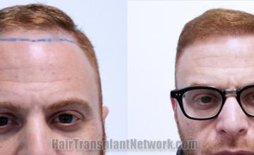 before and after result photographs