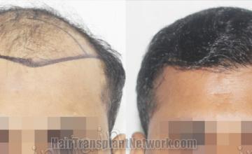 Front view - Before and after