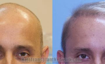 Front view - Before and after