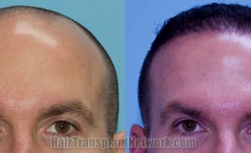 Front view - Before and after