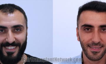 Front view - Before and after