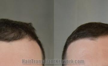 before and after result photographs