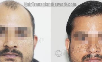 Front view - Before and after