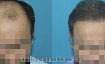 Front view - Before and after