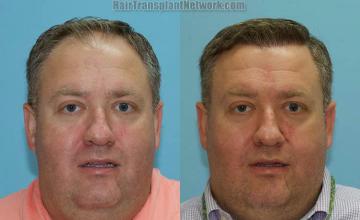 Front view - Before and after hair restoration procedure