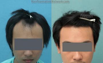 Front view - Before and after