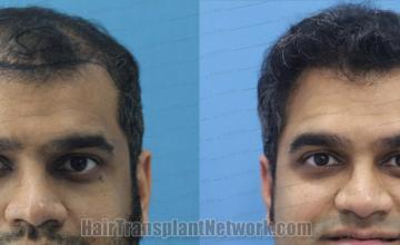 before and after result photographs