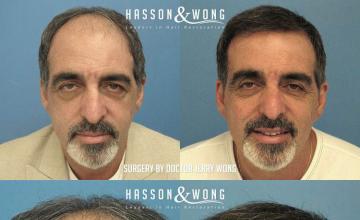 Before and after hair restoration procedure