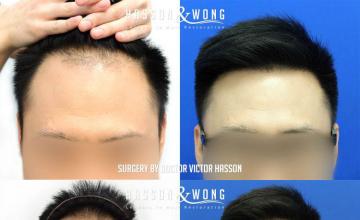 Front view - Before and after
