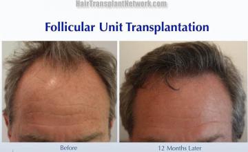 Front view - Before and after