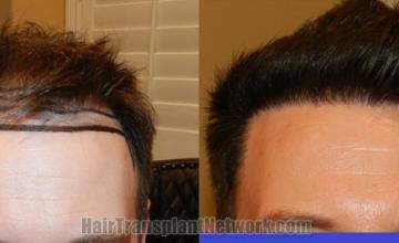before and after result photographs