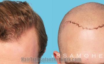 before and after result photographs