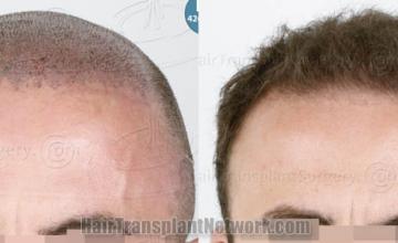before and after result photographs