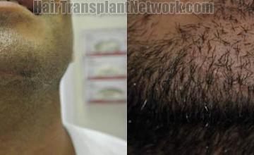 Hair restoration procedure before and after pictures