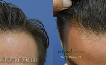 Before and after hair transplant restoration photos