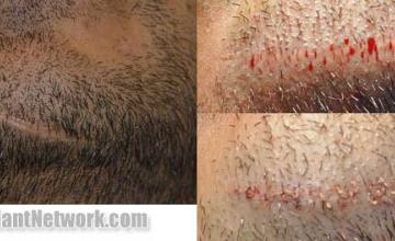 Hair transplantation surgery before and after pictures