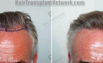 Hair transplantation surgery before and after images