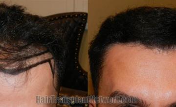 Front view - Before and after