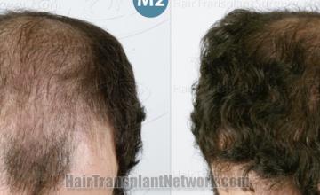 Hair restoration surgery before and after result photographs