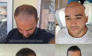 Hair transplantation surgery before and after photos