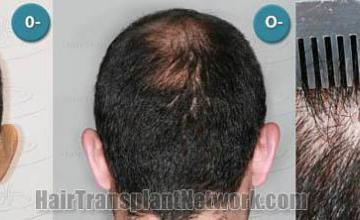  before and after images