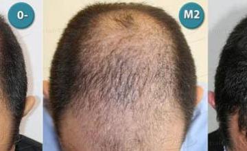 Hair transplantation surgery before and after pictures