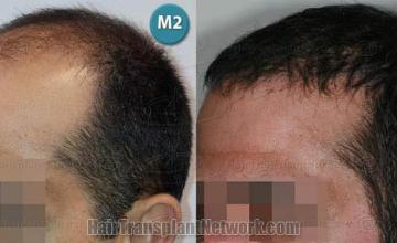  before and after photos