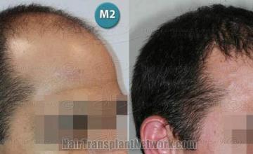 Hair restoration procedure before and after pictures