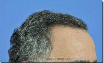 Hair restoration procedure results