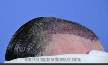 Hair restoration procedure results