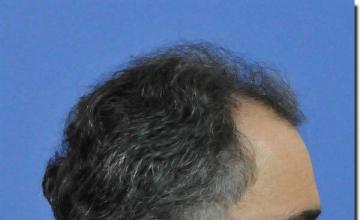 Hair restoration procedure results