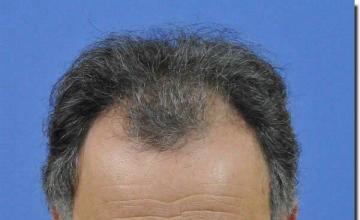 Hair restoration procedure results