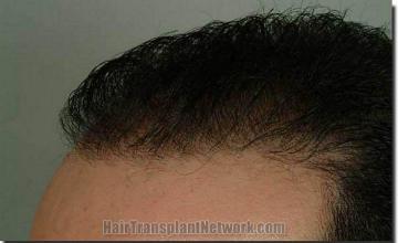 Hair restoration procedure results