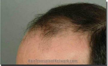 Hair restoration procedure results