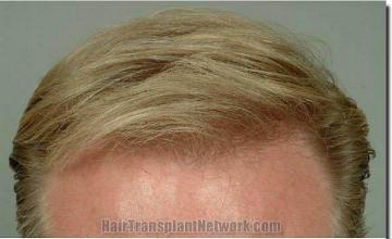 Hair restoration procedure results