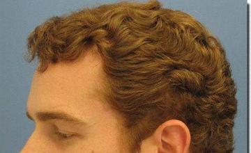Hair restoration procedure results