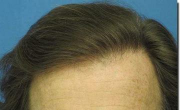 Hair restoration procedure results