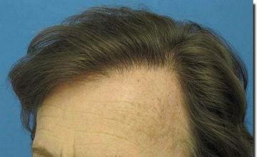 Hair restoration procedure results