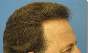 Hair restoration procedure results