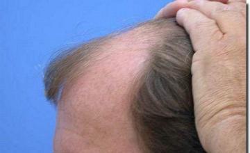 Hair restoration procedure results