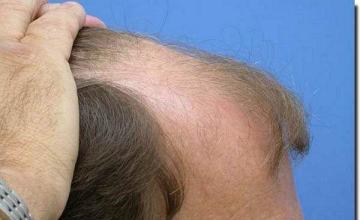 Hair restoration procedure results