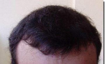 Hair restoration procedure results