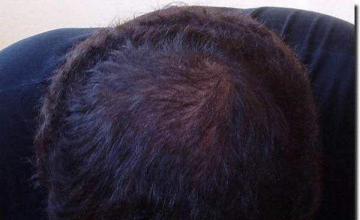 Hair restoration procedure results