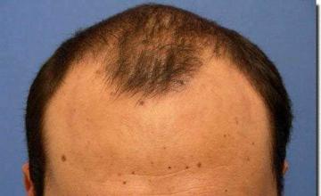 Hair restoration procedure results