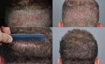 Hair restoration procedure before and after pictures