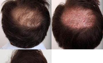 Hair transplantation surgery before and after pictures